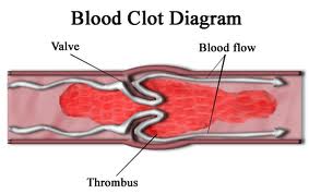 blood clot